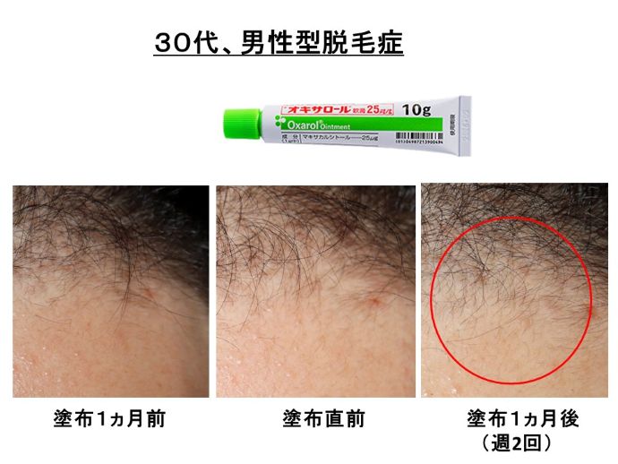 円形脱毛症　病院